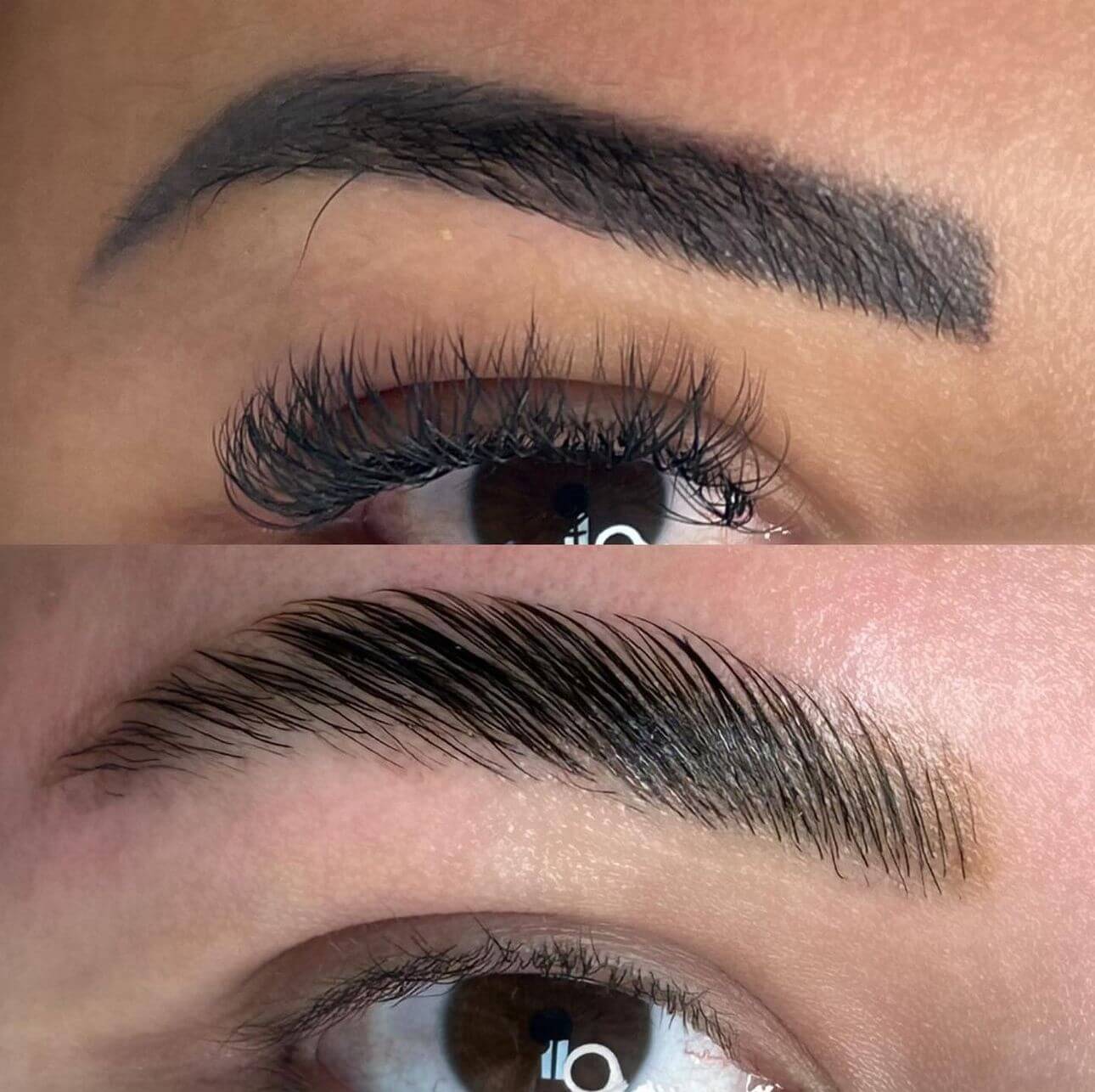 Remoção a Laser de sobrancelhas 